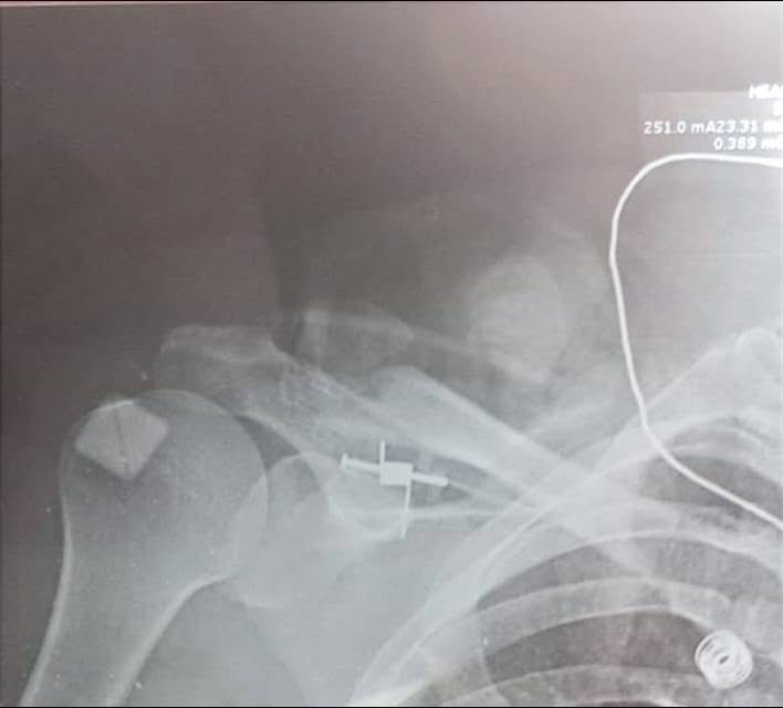 Distal clavicle fracture x-ray with locking plate fixation