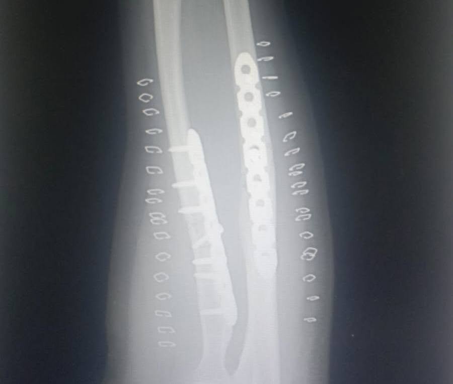 Adult forearm fracture x-ray after locking plate fixation