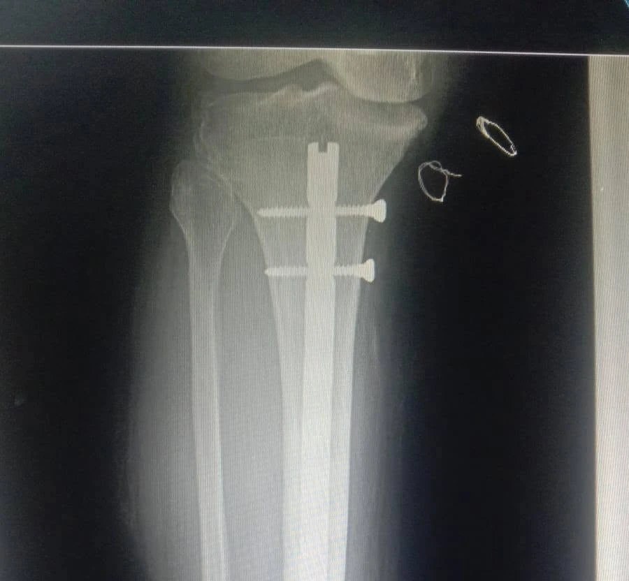 Tibial shaft fracture x-ray after expert nailing technique
